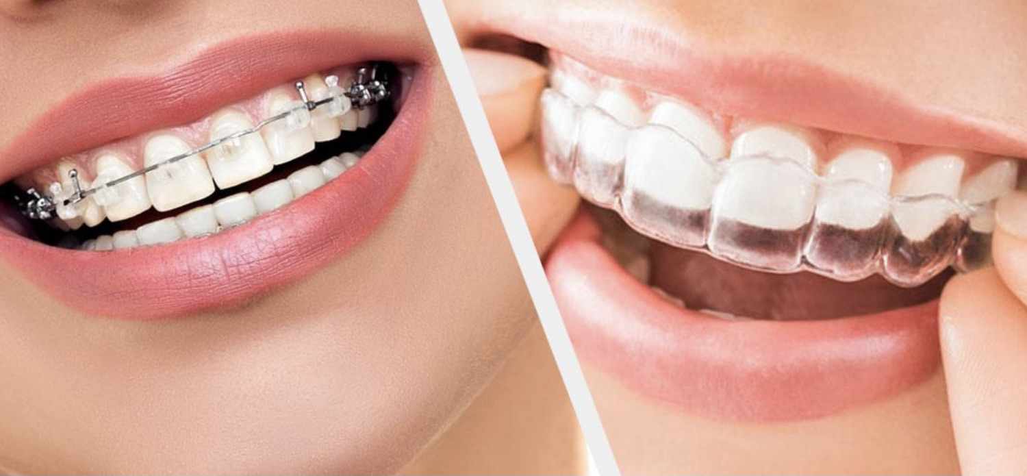 What Is the Right Age for Braces Treatment in Ulwe? Expert Guide