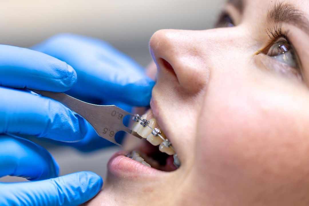 Braces Treatment for Adults: Is It Too Late to Get a Perfect Smile?