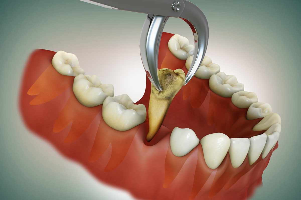 Tooth Extraction Pain Explained: What Happens Before, During, and After